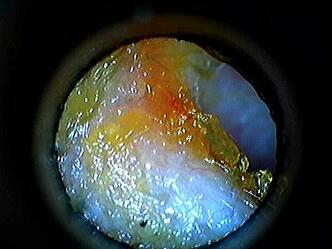 Picture Of Ear Canal With Wax