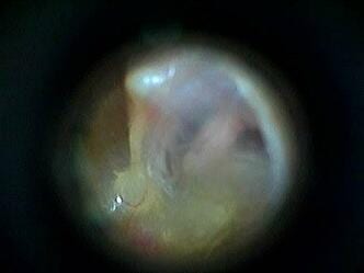 Picture Of Clean Ear Canal