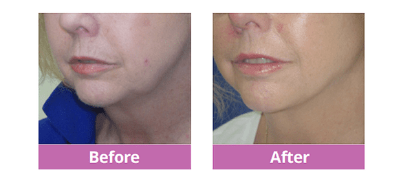 Liquid Facelift with Spot Liposuction to Jowls Before and After