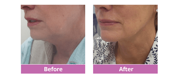 Liquid Facelift with Spot Liposuction to Jowls Before and After