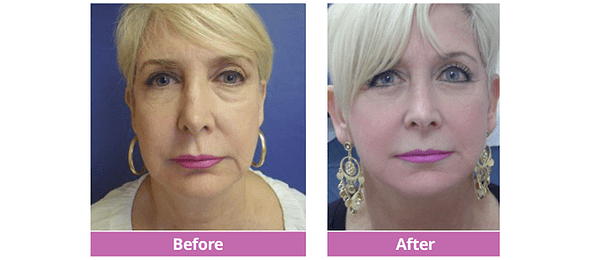 Full Facelift Before and After