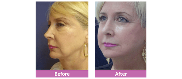 Full Facelift Before and After Side View