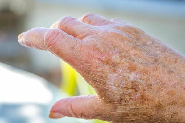 How to fade age spots on hands