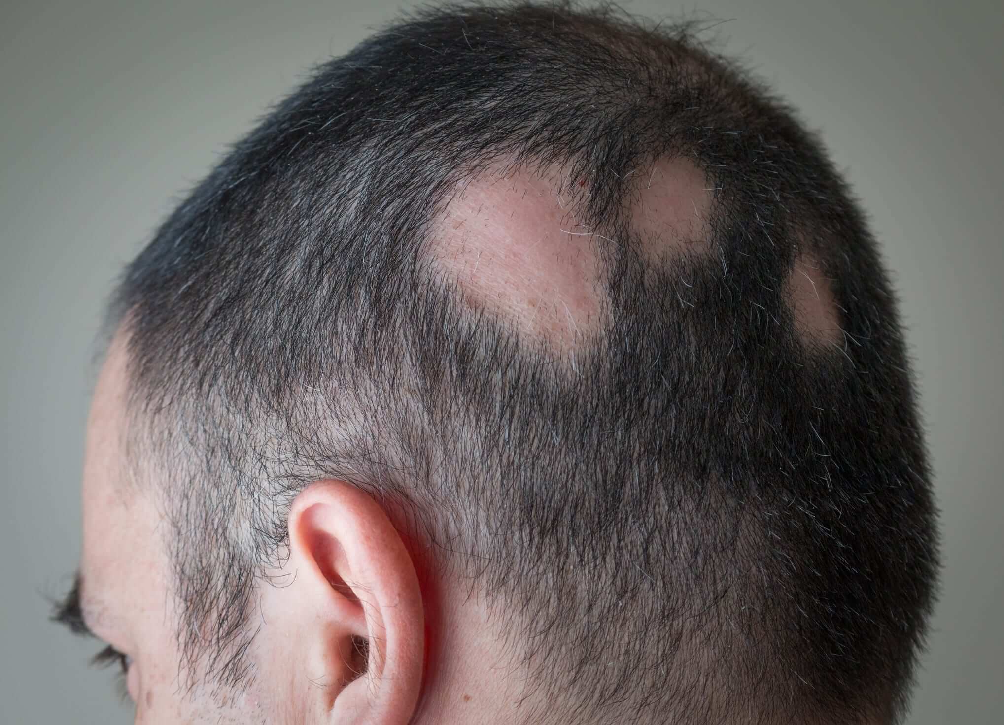 How Injections Can Help With Hair Loss