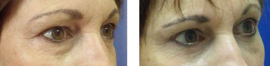 Blepharoplasty before and after photos