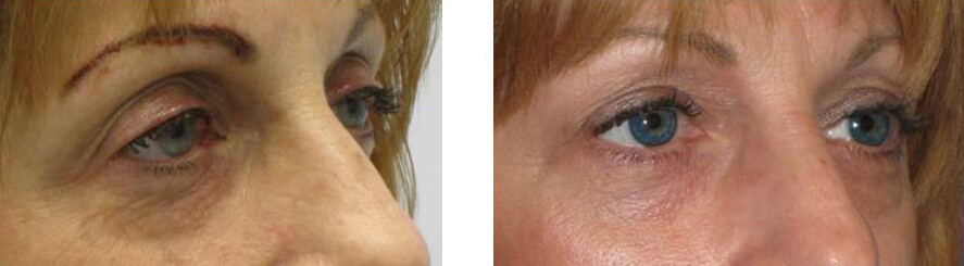 Eyelid Surgery before and after photos