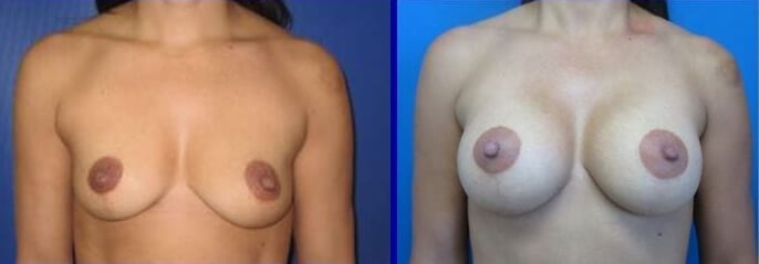 Breast Augmentation before and after photos
