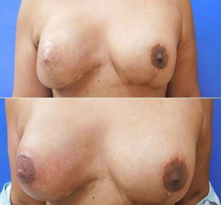 Breast Reconstruction before and after photos