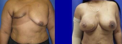 Female Breast Reconstruction before and after photos