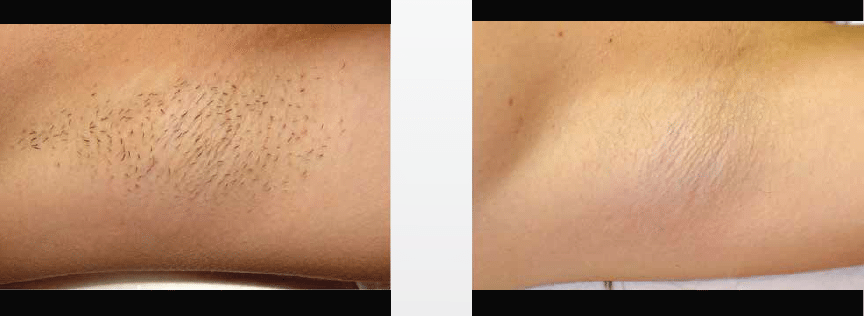 Laser Hair Removal at Advanced Specialty Care is performed by fully-licensed Skincare nurses at our offices in Danbury, New Milford, Ridgefield, Norwalk & Stamford, CT.