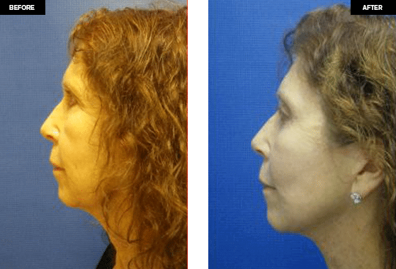 Face Lift surgery before and after Photos