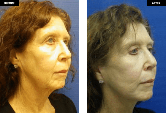 Face Lift before and after Photos
