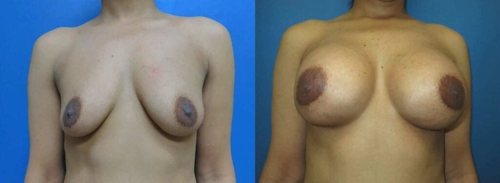 Breast Implants surgery before and after photos