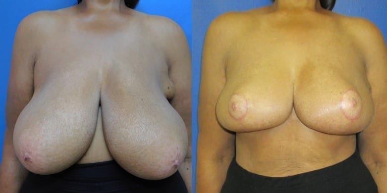 Breast Reduction before and after Photos