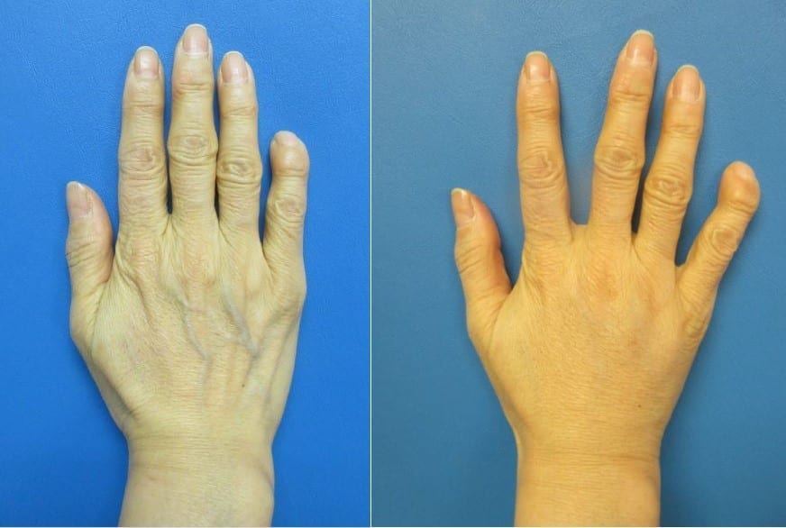 Radiesse Hand Rejuvenation Surgery before and after photos