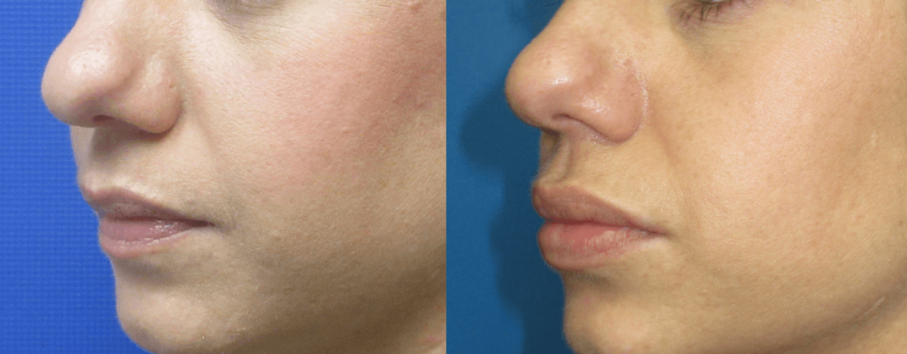 Lip Augmentation before and after photos