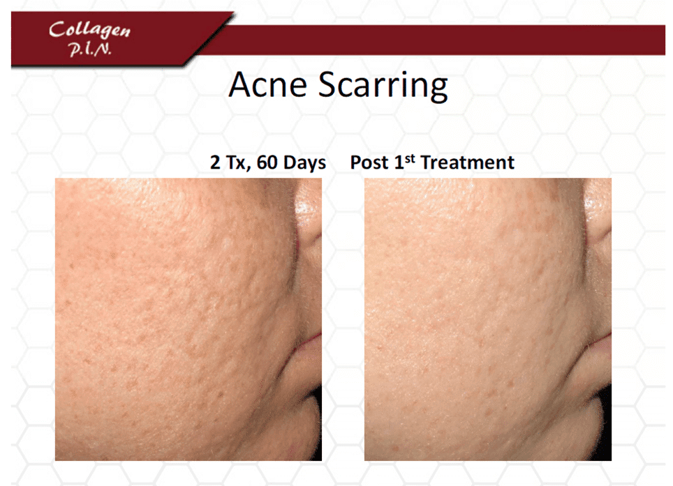 Acne Scarring Before and After Photos. 