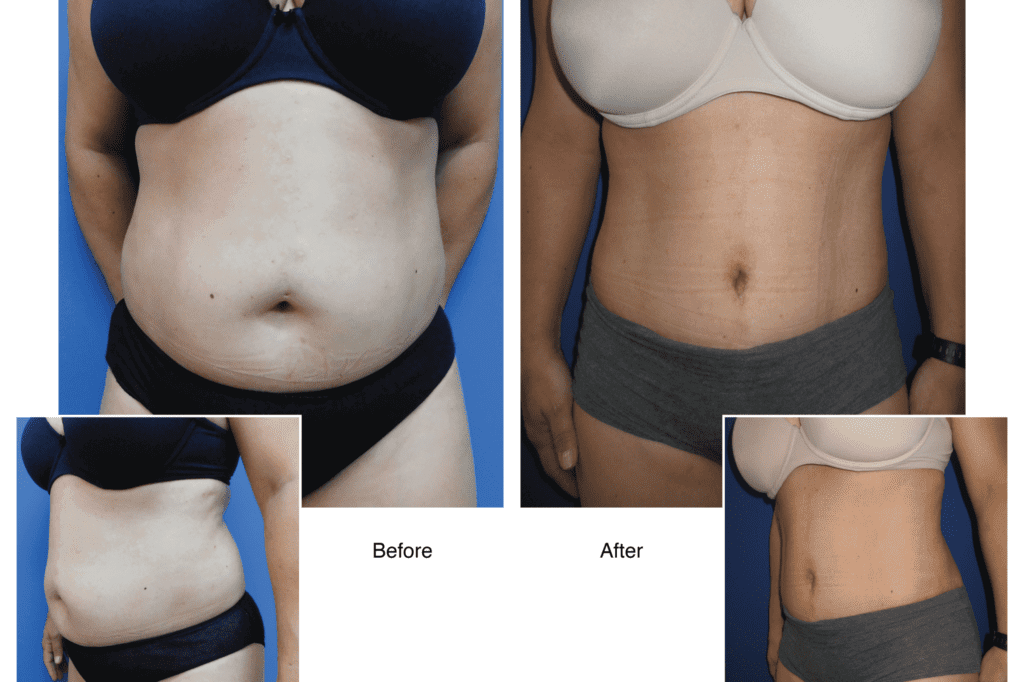 Tummy Tuck before and After Photo