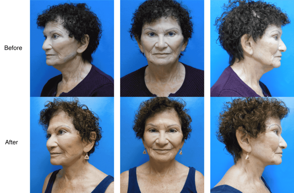 Neck Lift surgery before and after