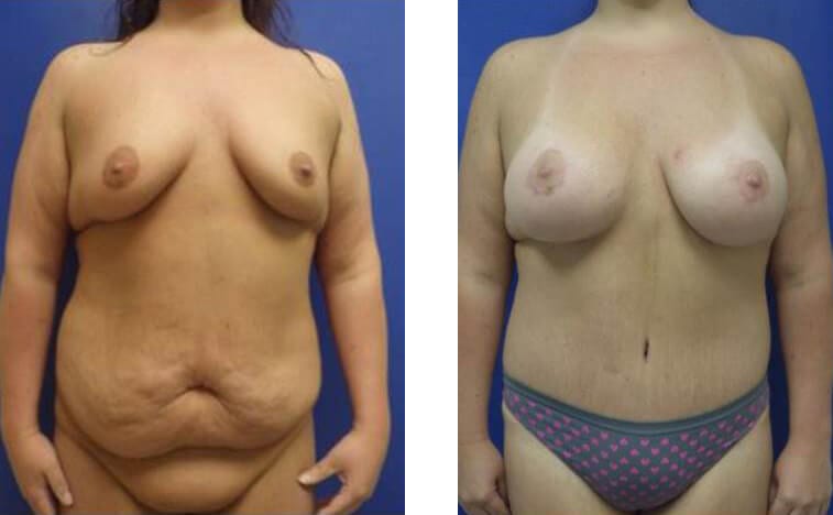 Abdominoplasty before and after photos