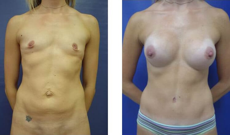 Breast implants before and after photos