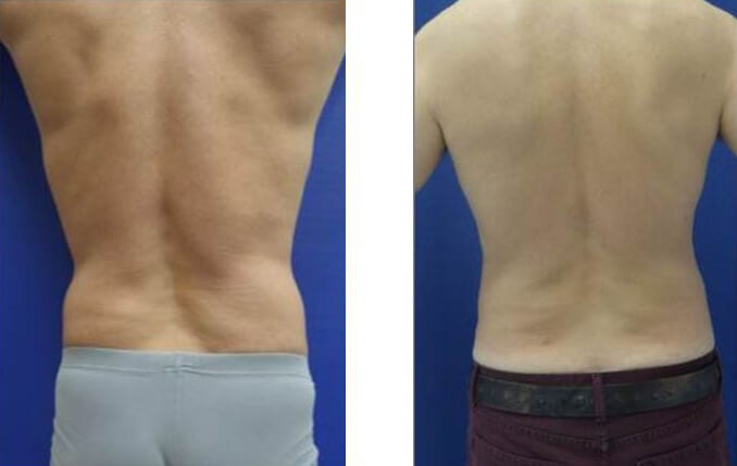 Liposuction Surgery before and after photos