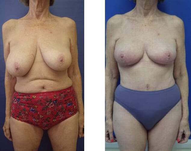 Female Breast Reduction before and after photos