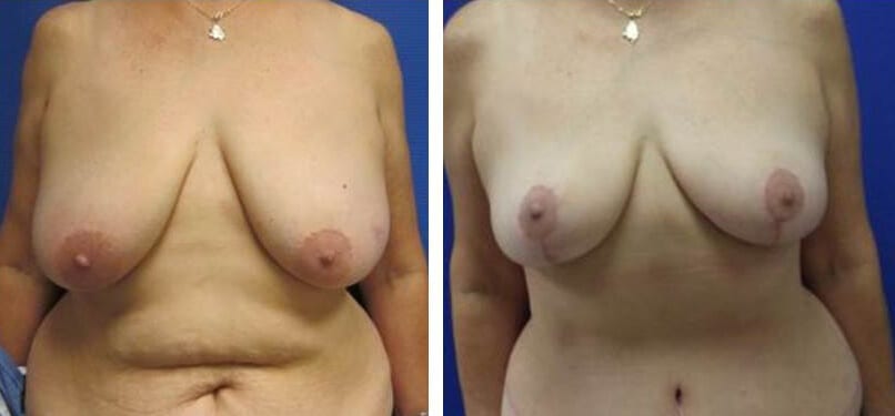 Breast Reduction before and after photos