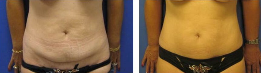 Liposuction Surgery before and after photos