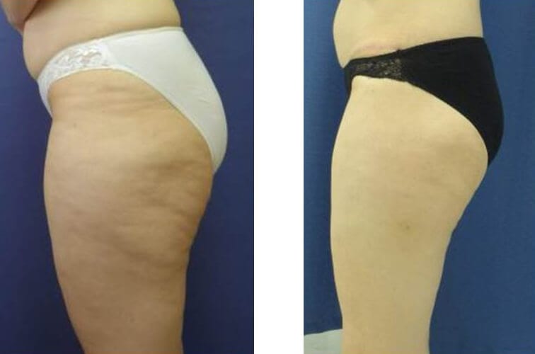 Liposuction surgery before and after photos