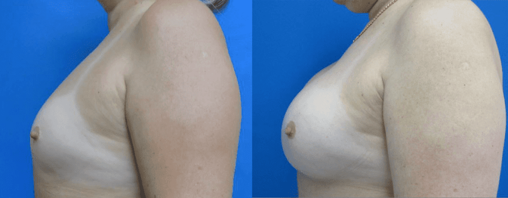 Breast Augmentation before and after photos
