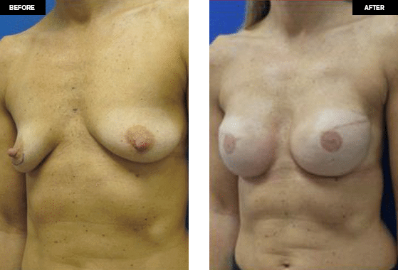 Breast Reconstruction before and after photos