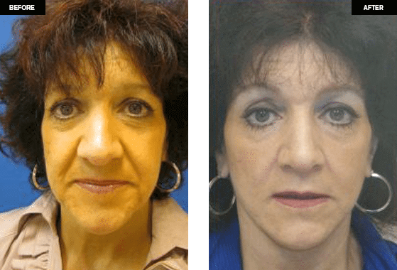 Facelift before and after photos