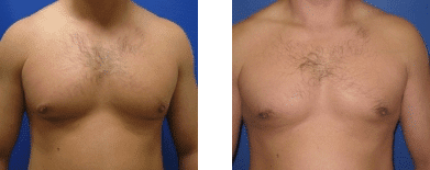 breast reduction before and after photos