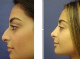 Nose Surgery before and after photos