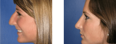 Nose surgery before and after photos
