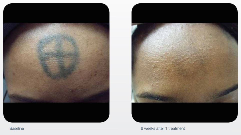 Laser Tattoo Removal Darien  Medical Spa Fairfield County CT