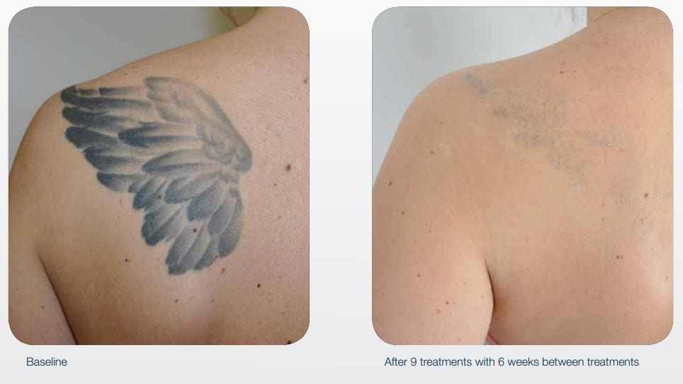 Connecticut Tattoo Removal  Safe  Permanent Tattoo Removals