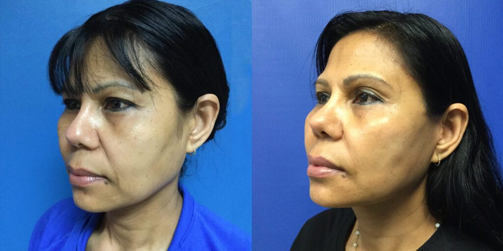 Mini Face Lift surgery Before & After