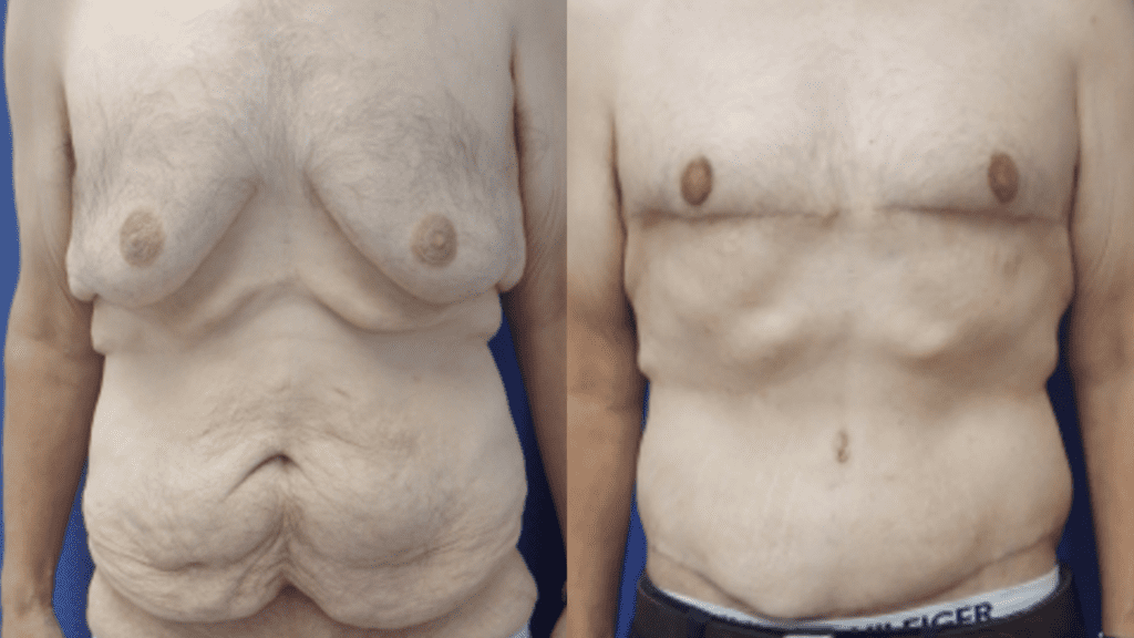 breast reduction before and after photos