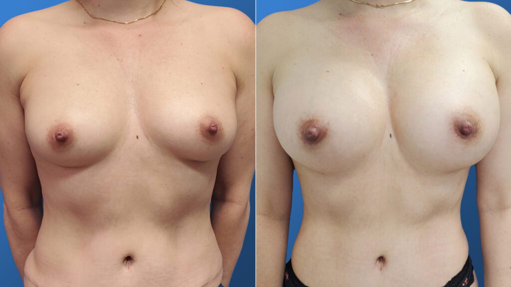 Breast Augmentation surgery photos