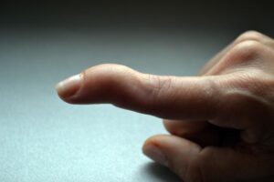 Mallet Finger is a condition in which the finger's tendon becomes damaged or even fully detached after an injury, with symptoms including swelling and stiffness.
