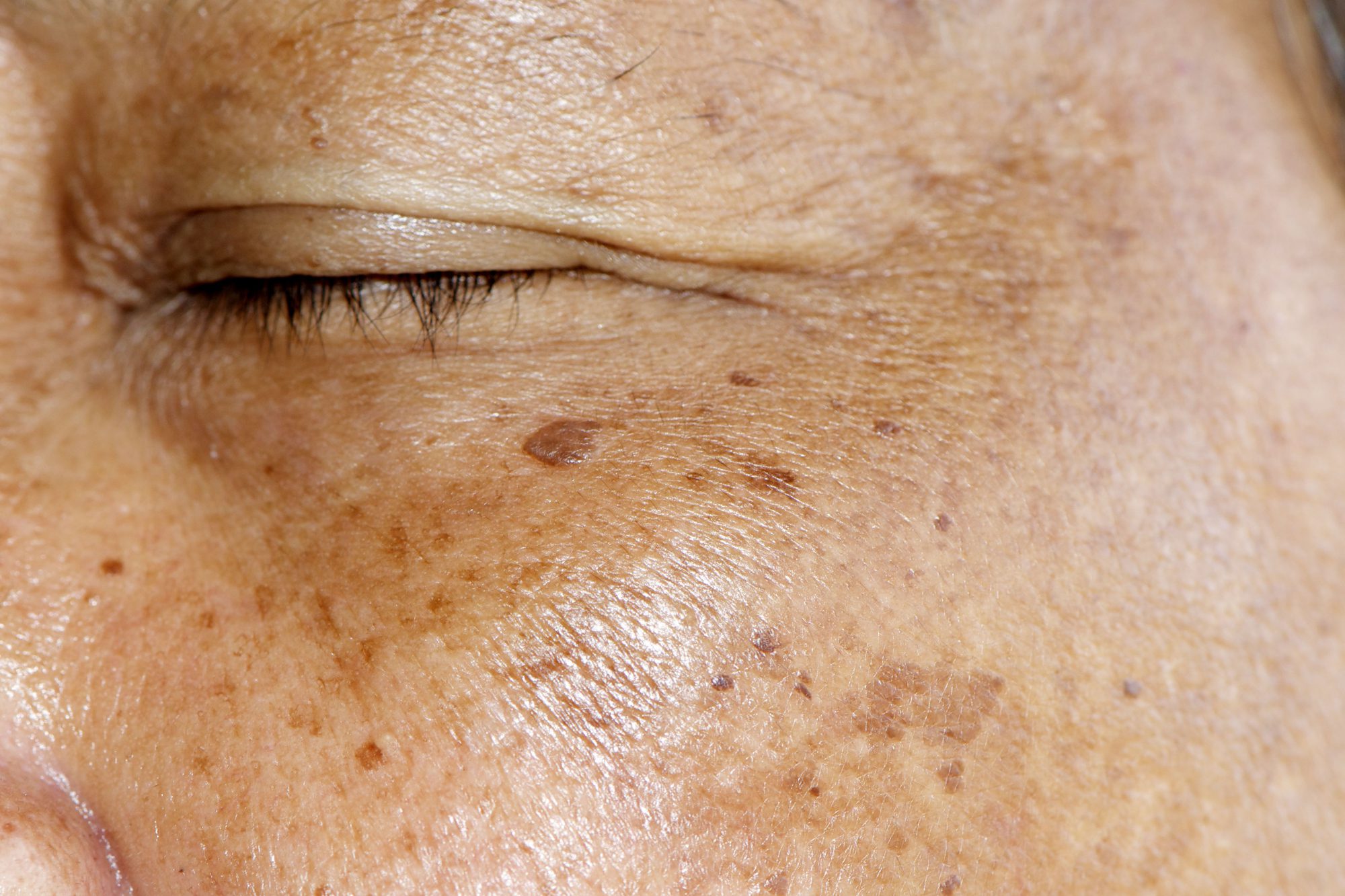 Age Spots are brown or black blemishes on the skin, appearing due to the natural aging process or sun exposure.