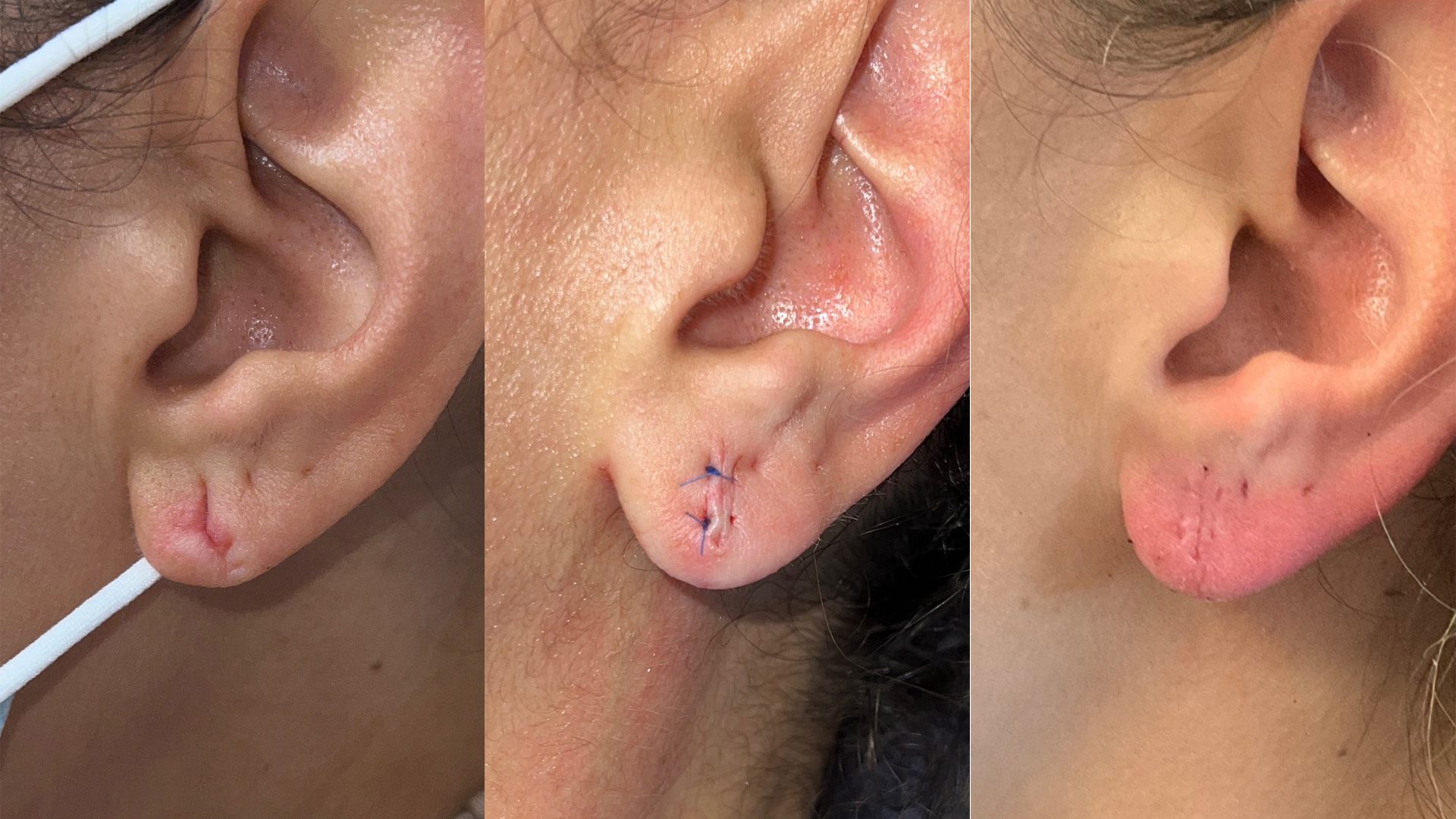 Earlobe Repair: What You Need To Know